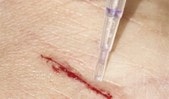 wound